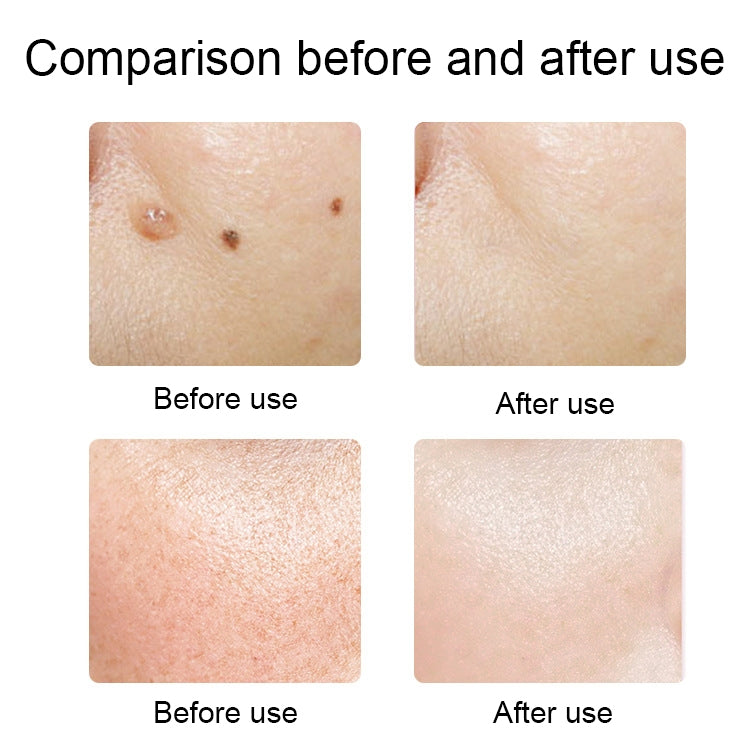 FY-106 Portable Mole and Freckle Removal Pen Household Laser Beauty Equipment(Gold) - Clothing & Beauty by PMC TechLife | Online Shopping South Africa | PMC TechLife